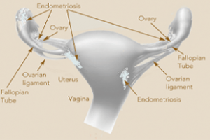 Planned Parenthood on X: March is Endometriosis Awareness Month